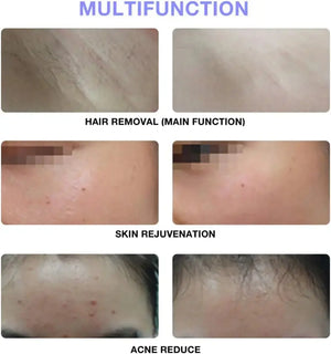 Intense Pulsed Light Uae Mart